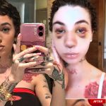 Bhad Bhabie shows off her nose job and reveals what type of cancer she has