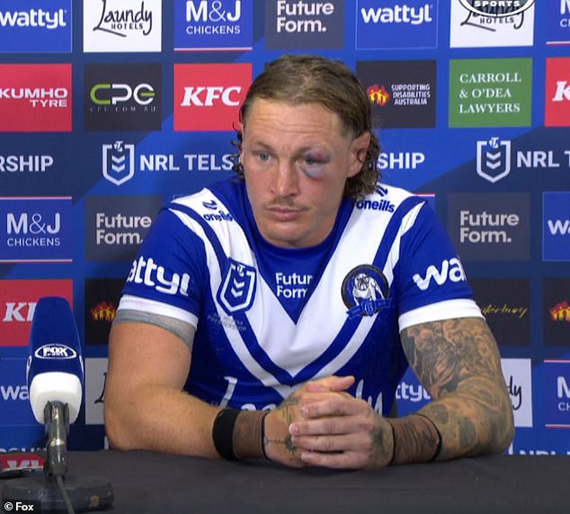 NRL Star Kurt Mann reveals a horrible black eye following the ugly 'clip' during the victory of Bulldogs'